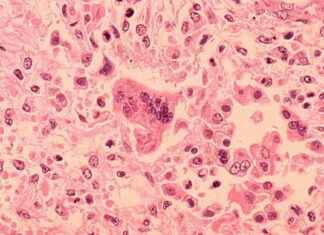 Measles Outbreak Alert: Cases in Chicago & O’Hare Airport measles-outbreak-alert-cases-in-chicago-ohare-airport